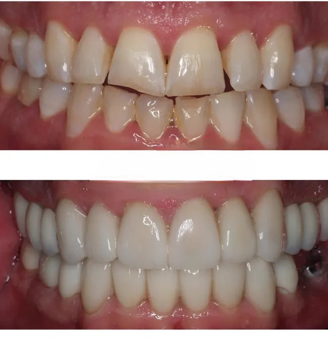 Before and after restoration of worn teeth with crowns and veneers