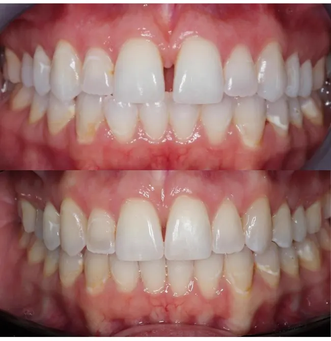 Before and after closing an upper front tooth gap with Invisalign