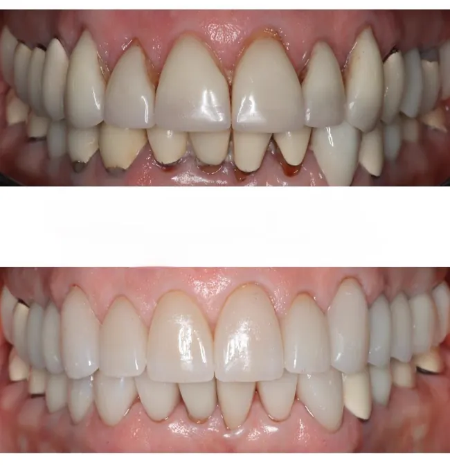 Before and after replacement of older dental crowns